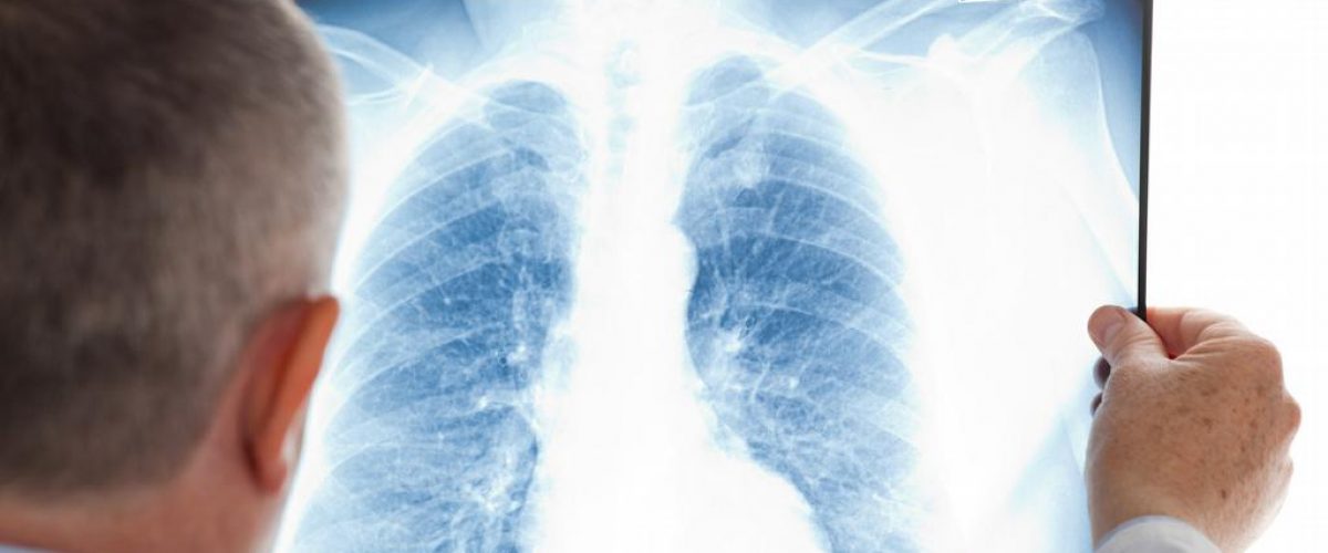 Você conhece a embolia pulmonar?