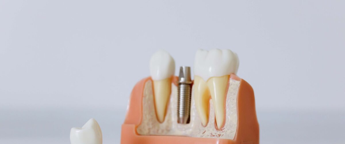 Implante dental: mitos e verdades